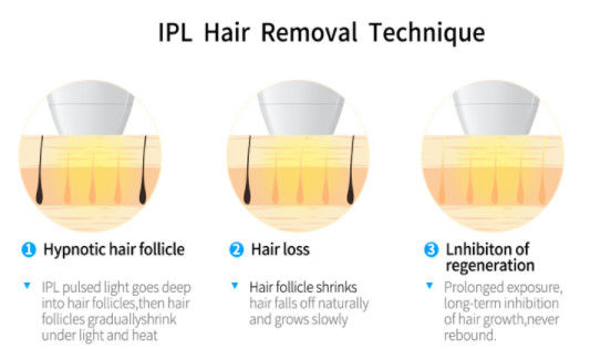 2000w technologie laser de DIODE de l'OPT IPL+ 808NM pour l'équipement d'épilation